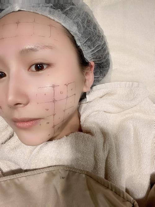 2025年澳门9点35分07和脖子被扎多根烧烤签与被烧烤签子扎出血了